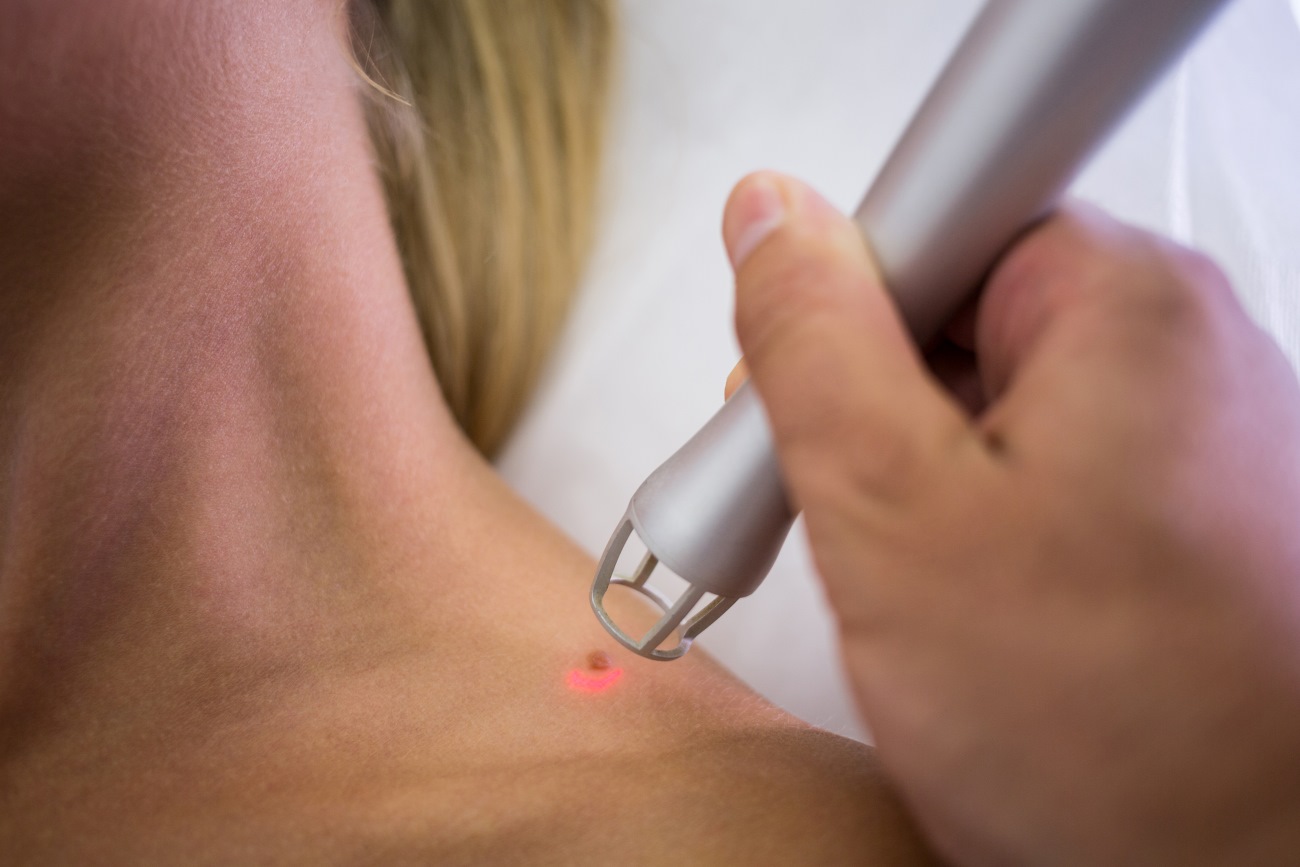 Skin Cancer Checks Mornington